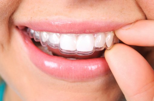 The Top 3 Advantages of Invisalign