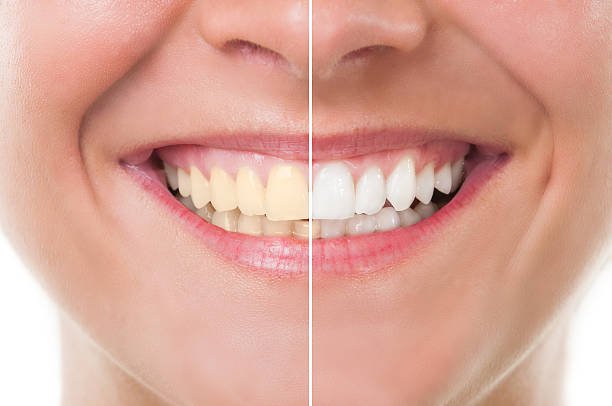 Teeth whitening with our cosmetic dentist in Marshville, NC