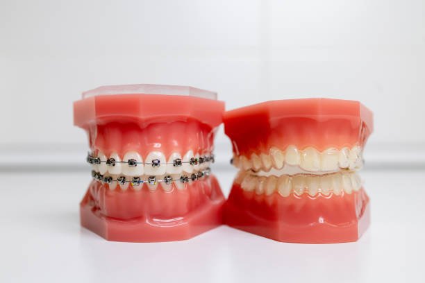 Invisalign vs. Traditional Braces, Dr. Tran Weighs in on the subject in Marshville near Monroe, Peachland, Wingate, NC, and Pageland, SC