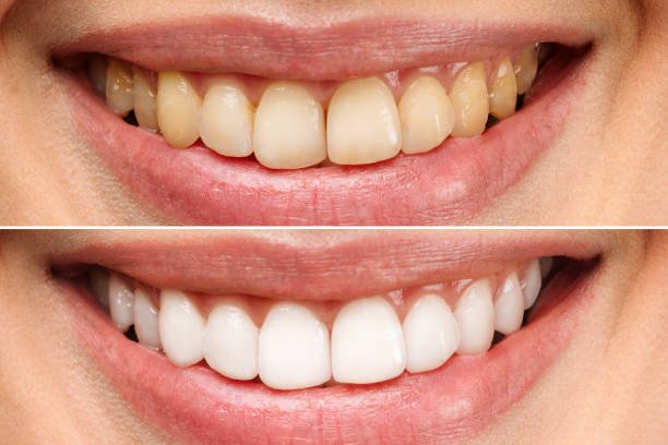 Discover Teeth Whitening Options in Marshville, near Monroe, Peachland, Wingate, NC, and Pageland, SC